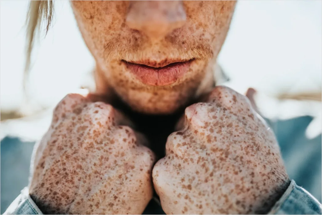 Detail Freckles Close Up Number 16