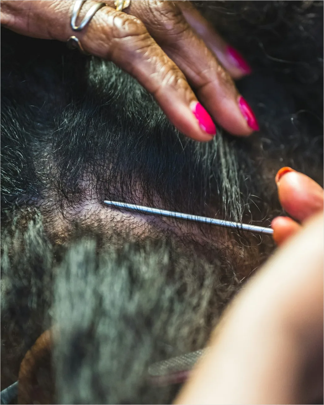 Detail Acupuncture Needles Close Up Treatment Number 5