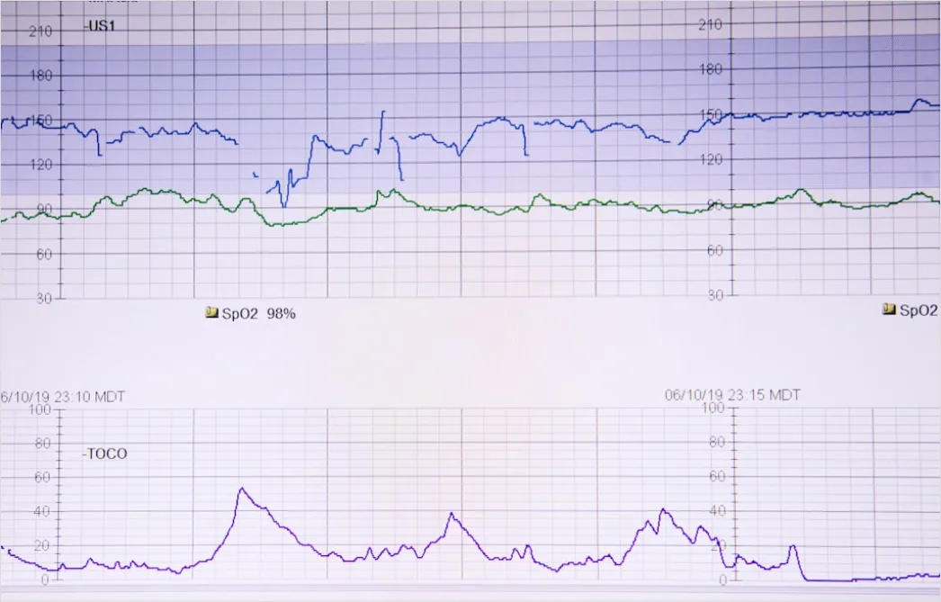 Detail Icu Monitor Alarms Waveform Number 16