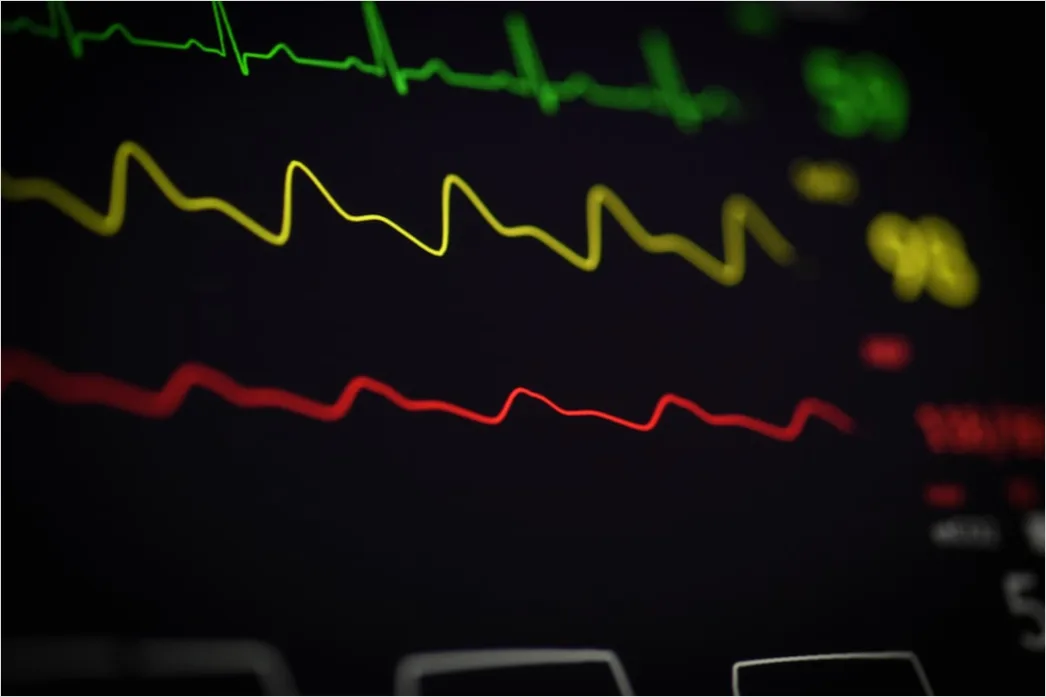 Detail Icu Monitor Alarms Waveform Number 3
