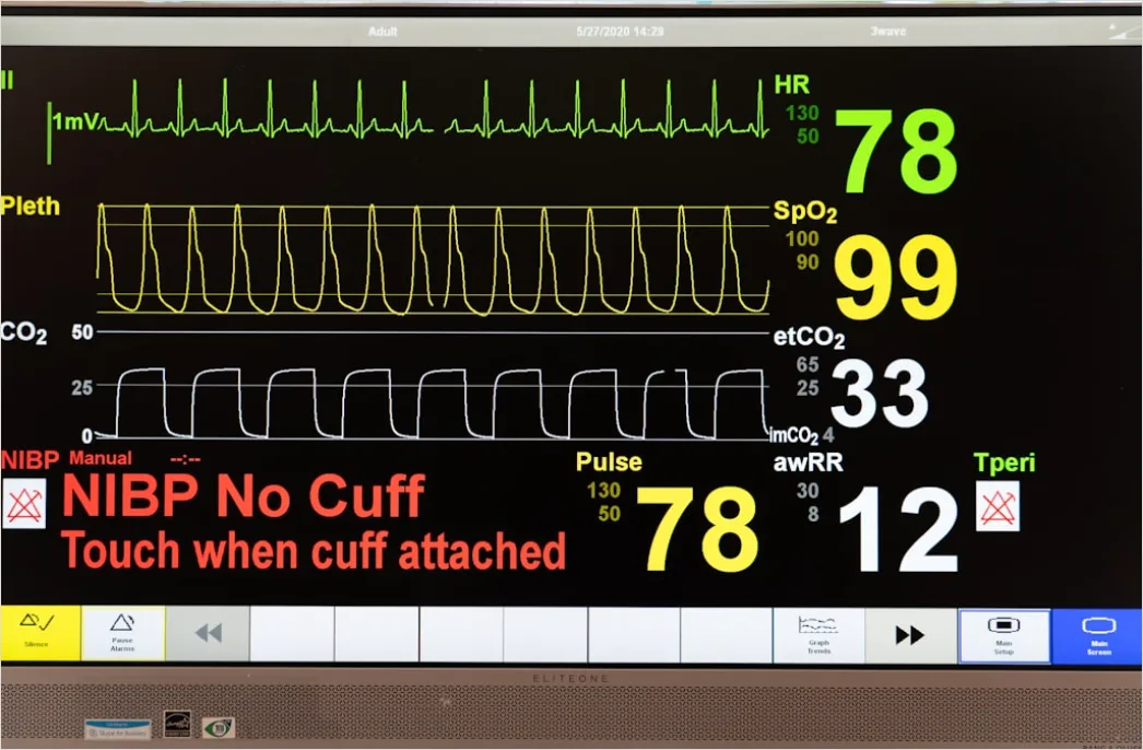 Detail Icu Monitor Alarms Waveform Number 7