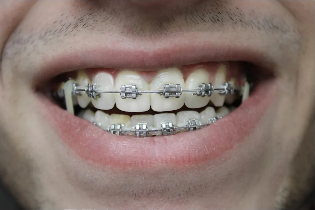 Orthodontic Braces Smile Close Up E697