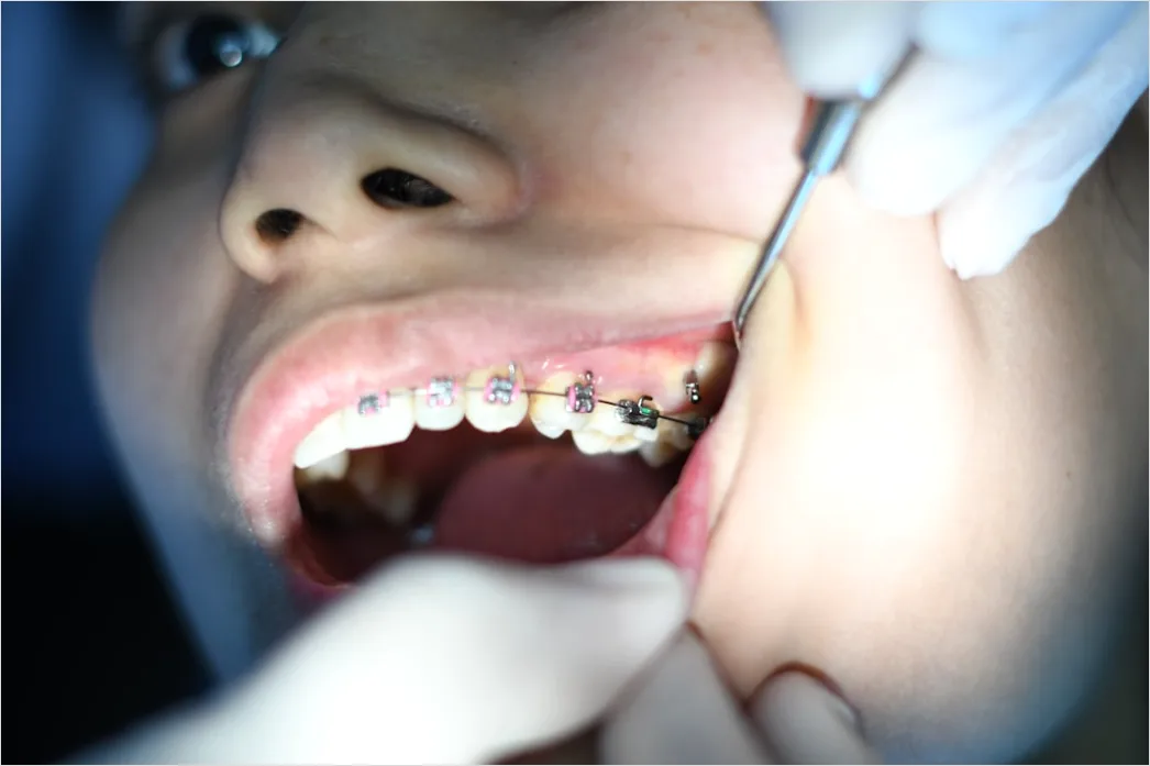 Detail Orthodontic Braces Smile Close Up Number 2