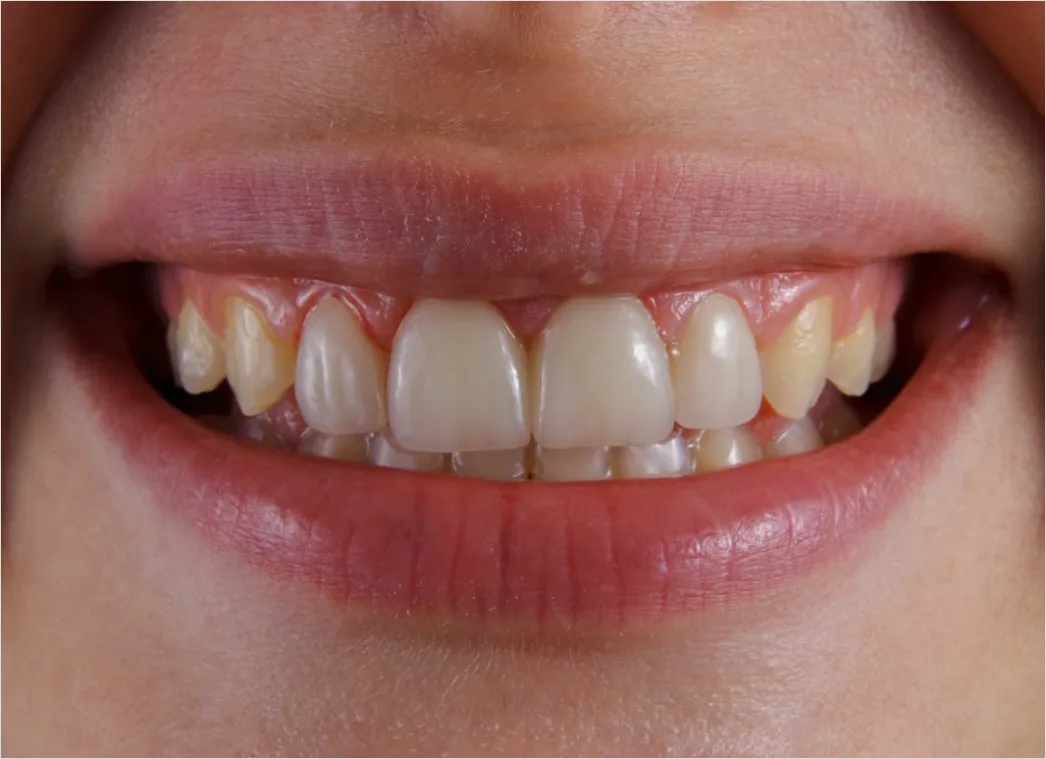 Detail Orthodontic Braces Smile Close Up Number 15
