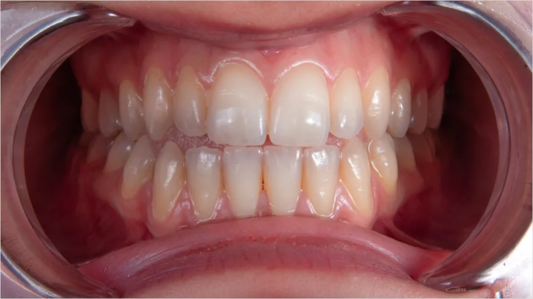 Detail Orthodontic Braces Smile Close Up Number 16