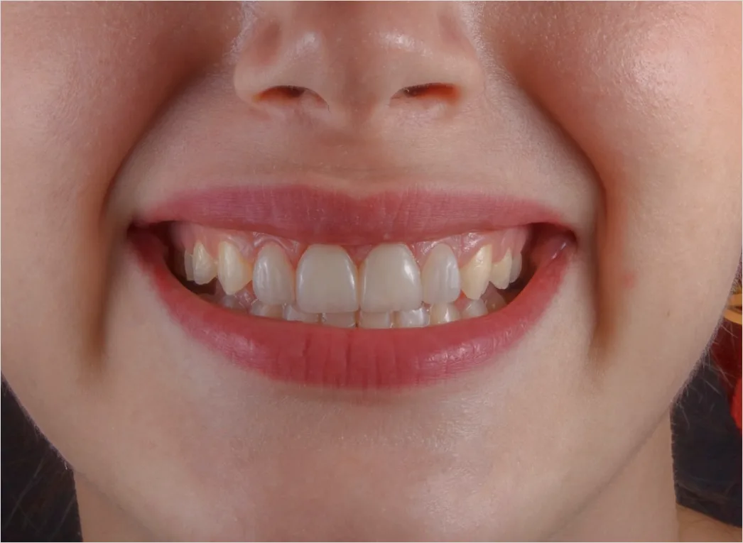 Detail Orthodontic Braces Smile Close Up Number 3