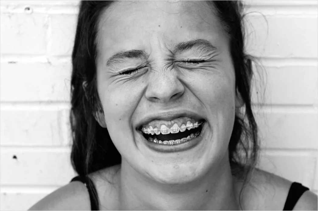 Detail Orthodontic Braces Smile Close Up Number 4