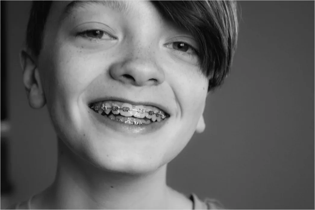 Detail Orthodontic Braces Smile Close Up Number 5