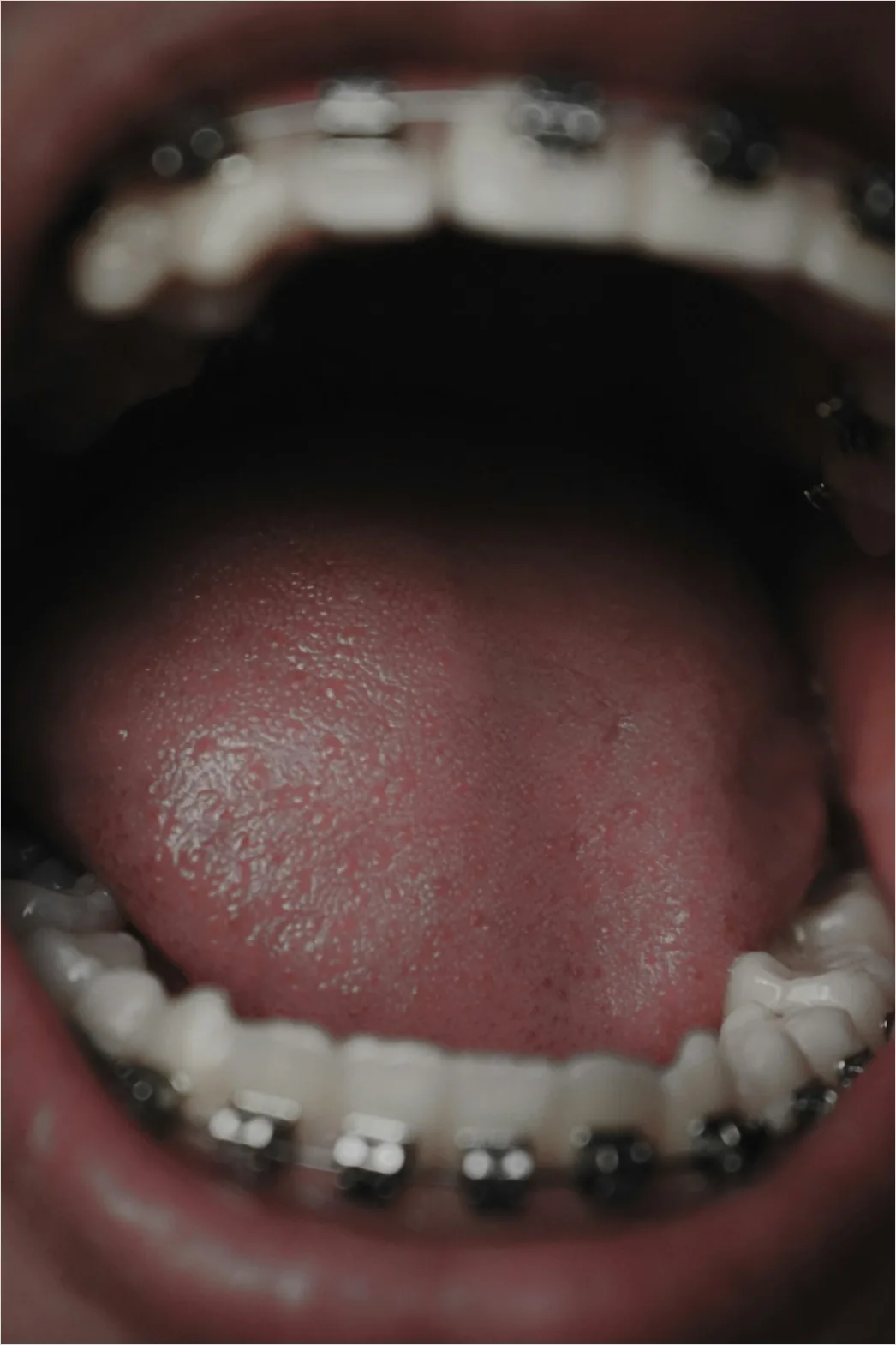 Detail Orthodontic Braces Smile Close Up Number 6