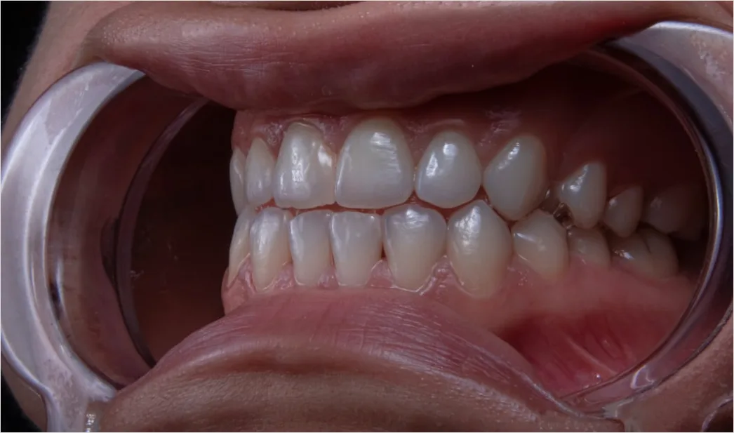 Detail Orthodontic Braces Smile Close Up Number 7