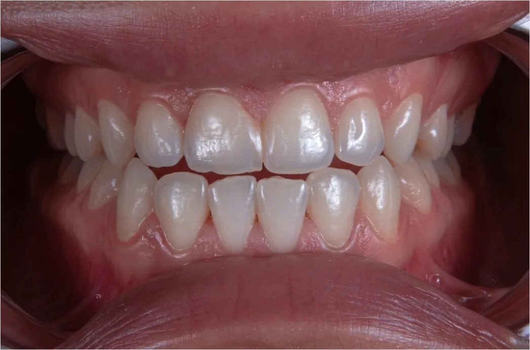 Detail Orthodontic Braces Smile Close Up Number 9